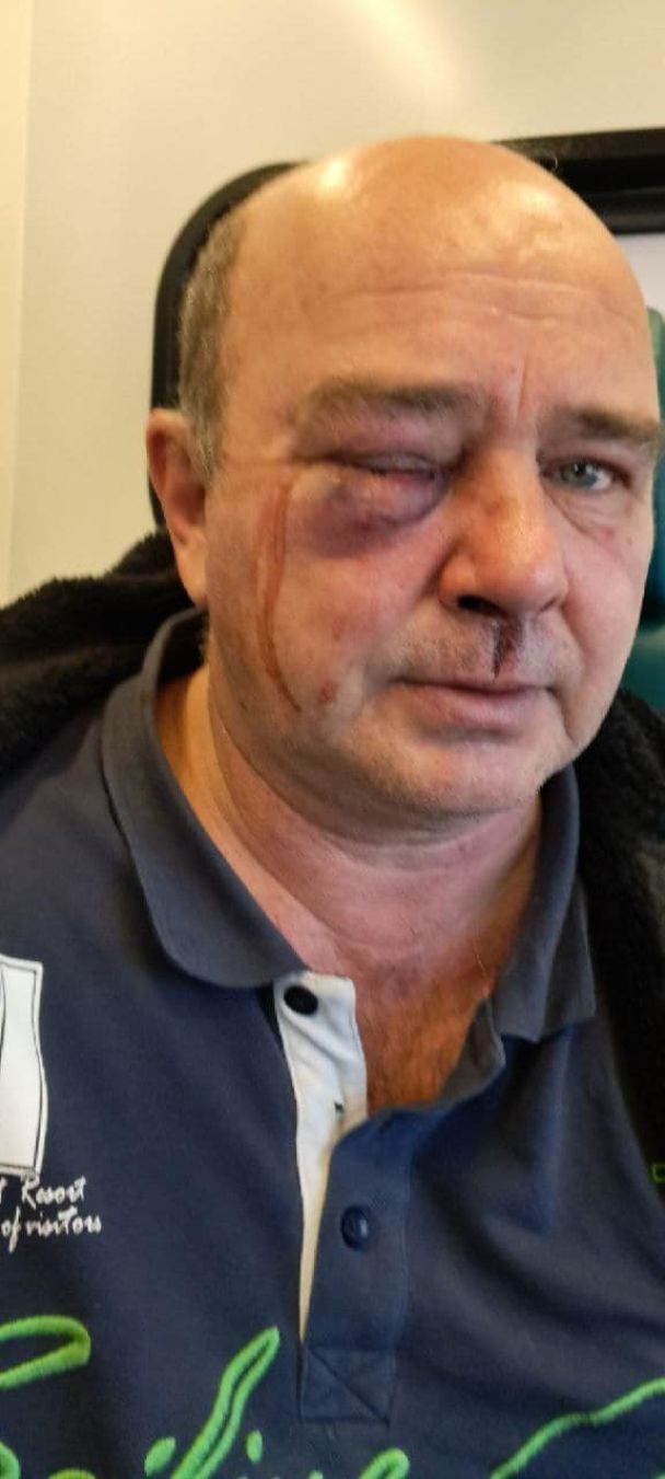 Чоловік, якого побили співробітники ТЦК на Київщині Фото/ Facebook: Вероника Кольцова / © 